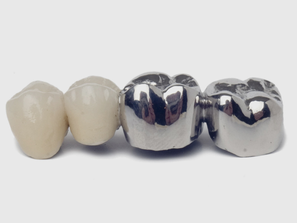 銀歯のリスク、ご存じですか？
