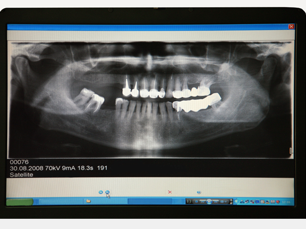 特徴01：歯科用CTを用いた精密な診断