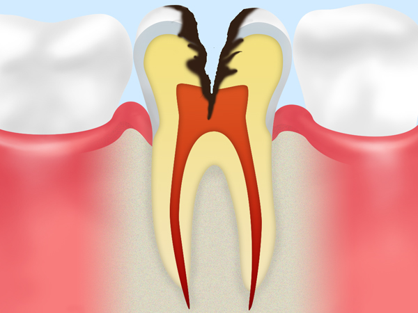 C3：歯髄（歯の神経・血管）に達した虫歯
