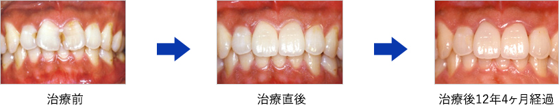 治療前 治療直後 治療後12年4ヶ月経過