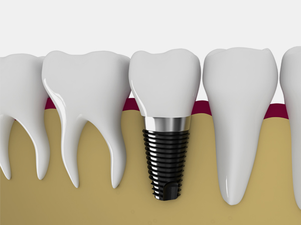 インプラント治療とは